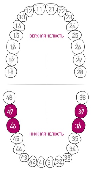 Кламп для коффердама Dentech (Япония) 51